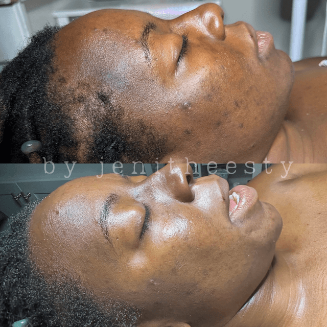 Facial Membership at Moonlight Skin Lab in Louisville, KY