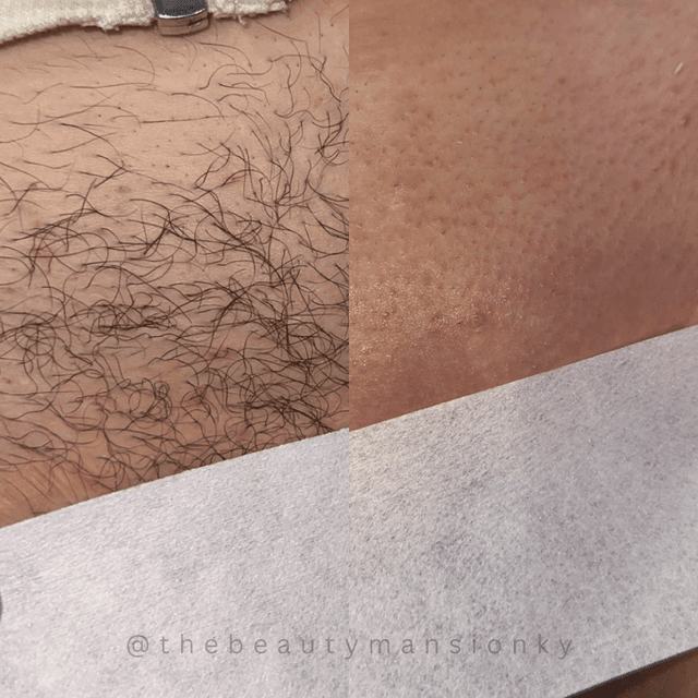Brazilian Member at Moonlight Skin Lab in Louisville, KY